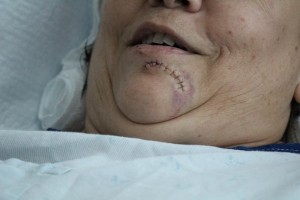 Evonne Cashman, was suffered injuries from a shark attack at Ulua Beach in South Maui on Wednesday, July 31, 2013. Photo by Wendy Osher.