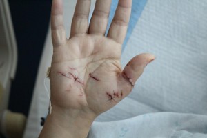 Evonne Cashman, was suffered injuries from a shark attack at Ulua Beach in South Maui on Wednesday, July 31, 2013. Photo by Wendy Osher.